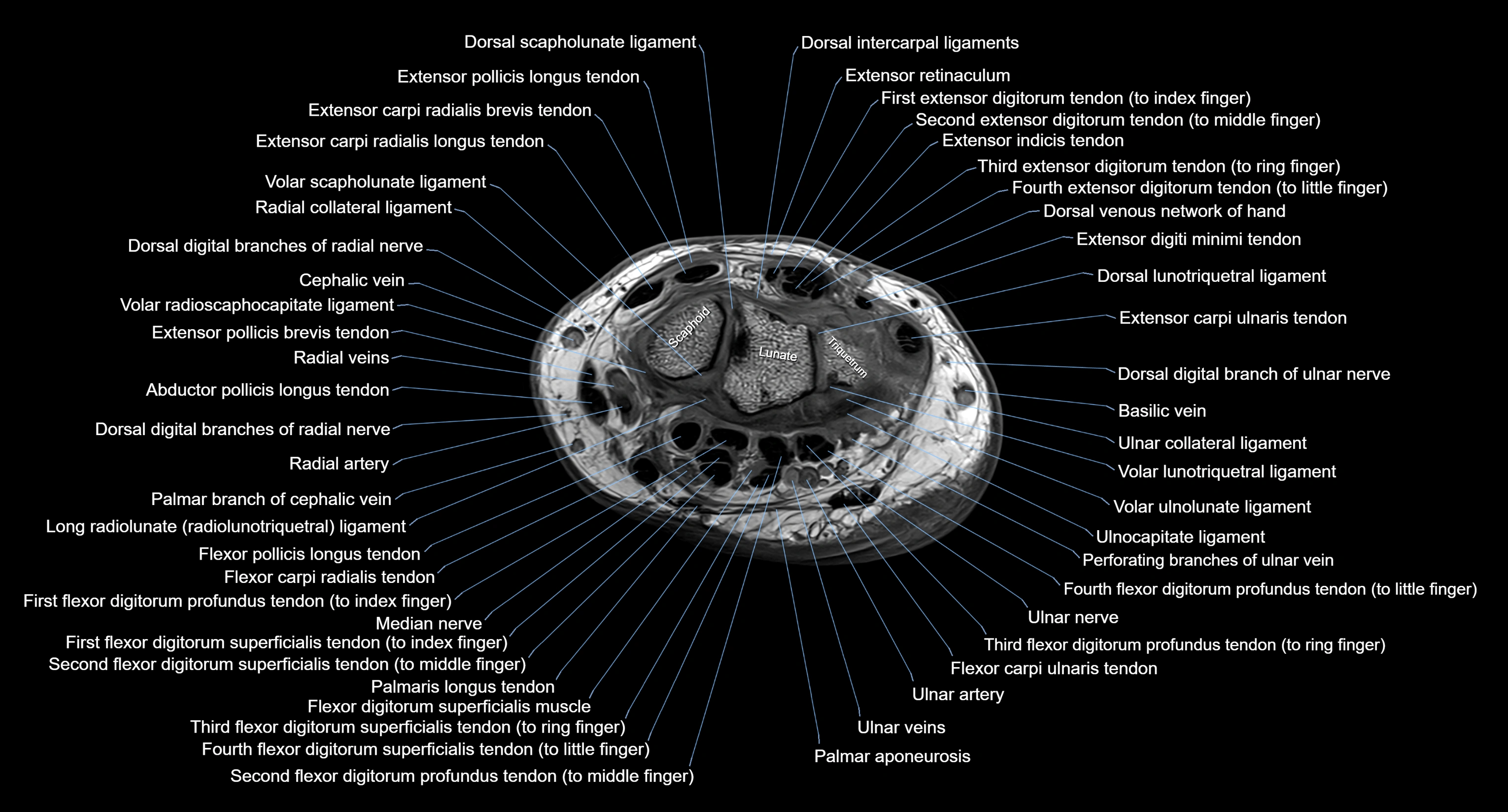 MRI wrist axial cross sectional anatomy 3T radiology  image-img-00001-00021.webp